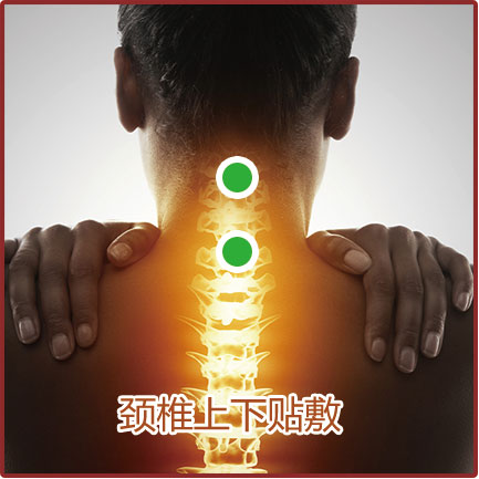 神經(jīng)根型、脊髓型頸椎病貼敷位置示意圖